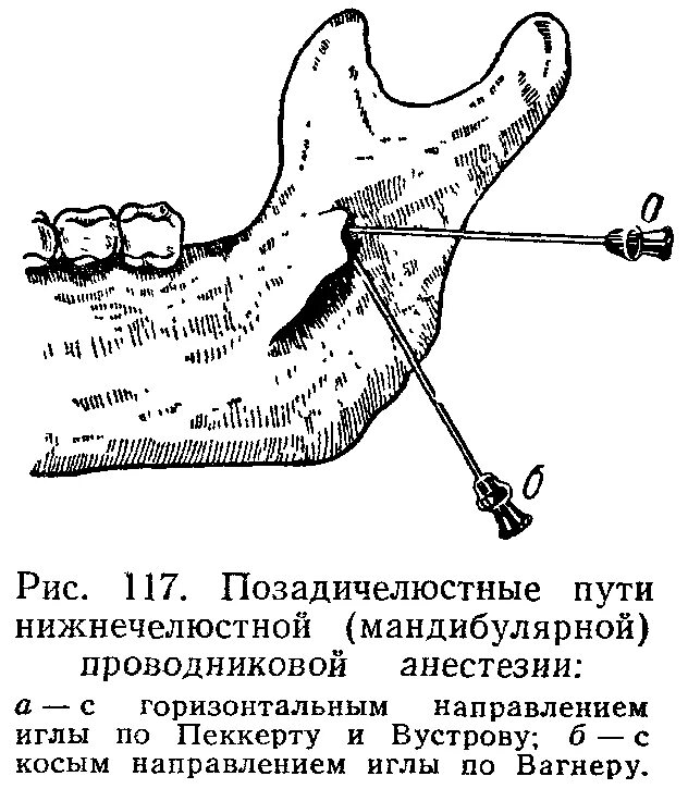 Проводниковая анестезия нижней челюсти мандибулярная. Проводниковая анестезия на нижней челюсти методика. Проводниковая анестезия нижней челюсти торусальная. Метод проведения мандибулярной анестезии. Проведение проводниковой анестезии