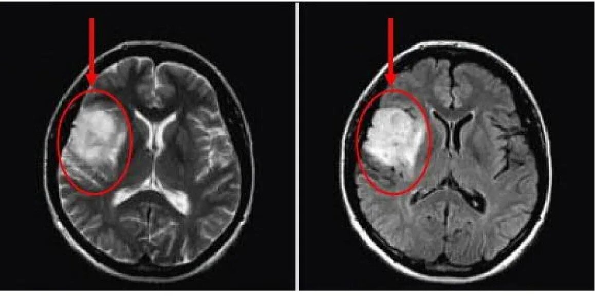 Опухоль головного глиома кт. На кт видно опухоль