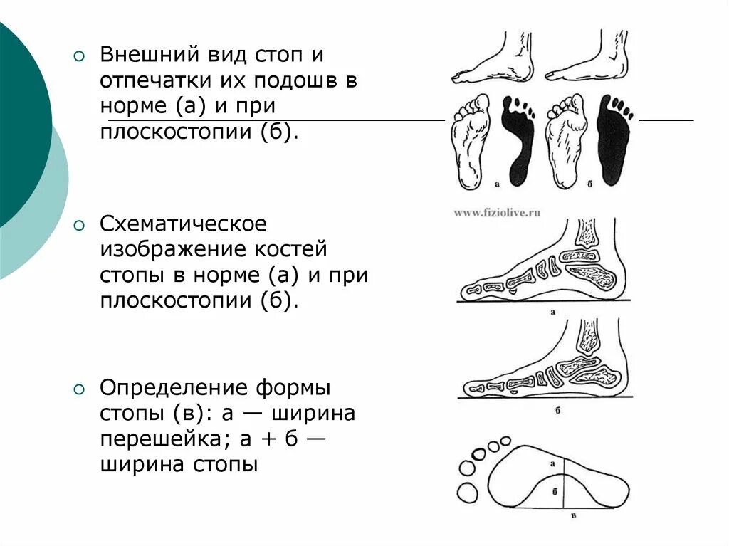 Средняя стопа. Плоскостопие вид сбоку. Степени плоскостопия сбоку. Отпечаток стопы при плоскостопии 3 степени. Нормальная стопа и плоскостопие.