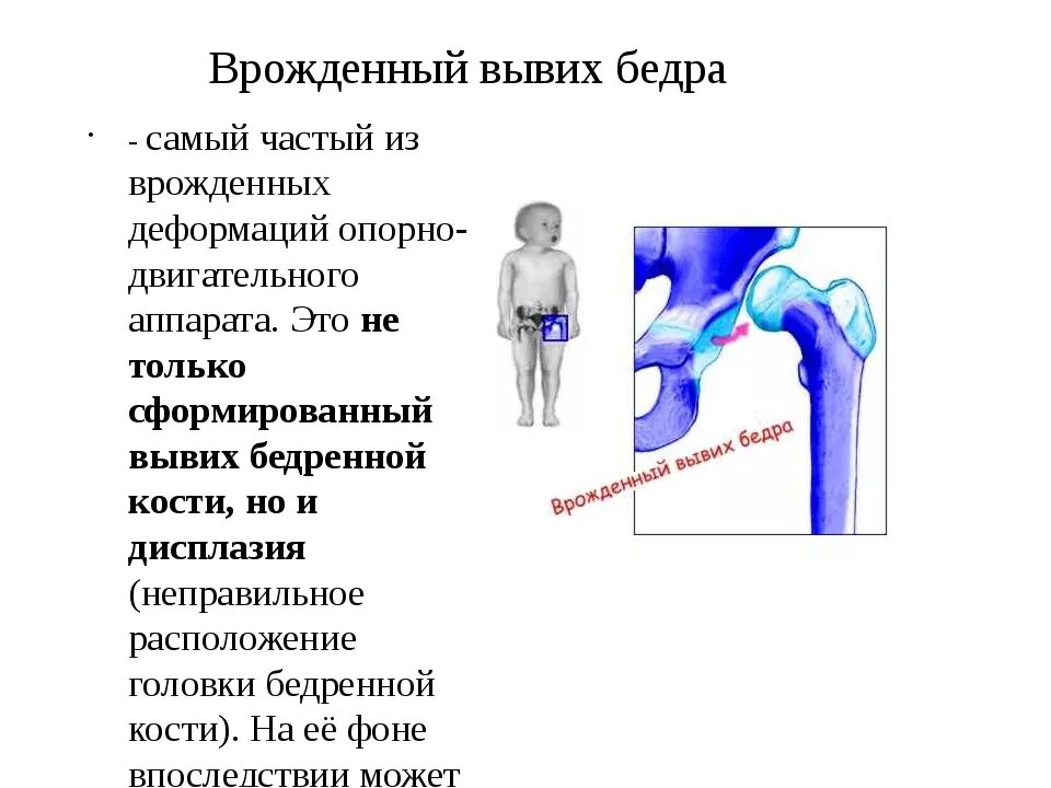 Вывих бедра тест. Механизм заднего вывиха бедра. подвывих тазобедренного сустава классификация. надлобковый вывих бедра рентген. вывих головки бедренной кости классификация.