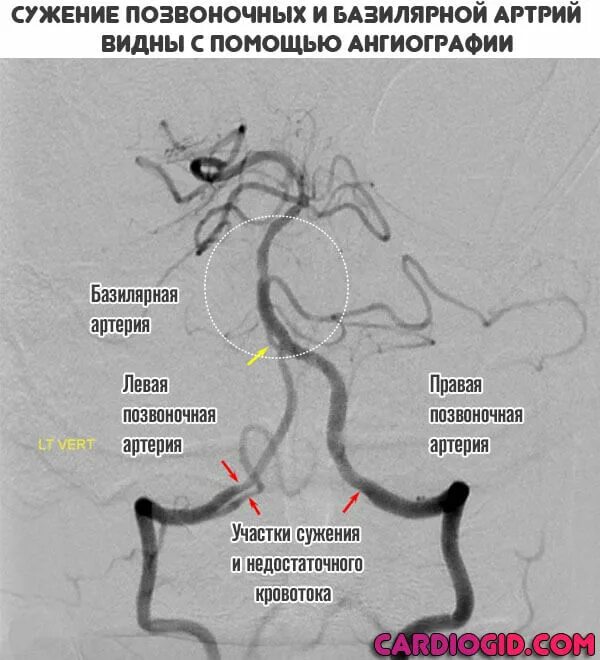 Вертебробазилярный синдром позвоночной артерии. Синдромы поражения базилярной артерии. Окклюзия базилярной артерии неврология. Стеноз 4 сегмента позвоночной артерии.