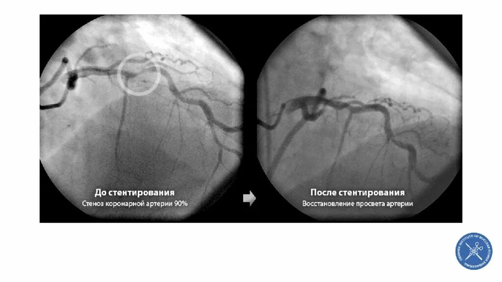 транслюминальная баллонная ангиопластика. коронарография сосудов стентирование. узи после стентирования. питание после стентирования коронарных сосудов сердца. стентирование осложнения.