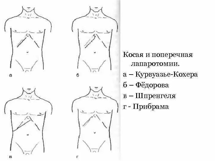 Какое лапаротомия. Срединная поперечная лапаротомия. Разрез Федорова лапаротомия. Разрезы кохера Федорова верхнесрединная лапаротомия. Доступ по Кохеру и по Федорову.