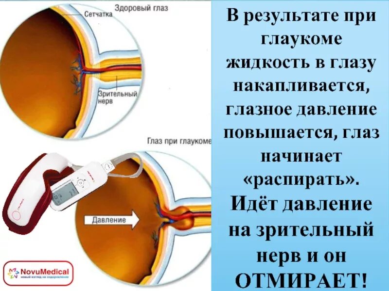 Внутриглазное давление глаза. Давление на сетчатку глаза. Глаукома норма внутриглазного давления.