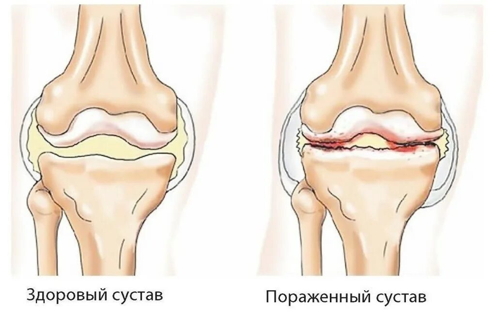 Артрит и артроз коленного сустава. Липартрит коленного сустава. Полиартрит коленный сустав лечение. Полиартрит коленный сустав лечение. Полиартрит коленный сустав лечение.
