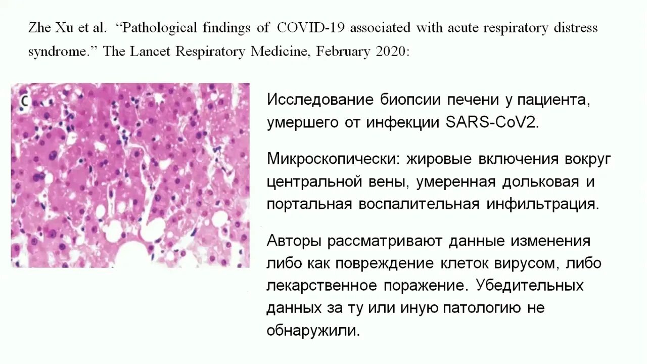 18 версия ковида. Covid 19 патологическая анатомия. Новая коронавирусная инфекция Covid 19 патологическая анатомия. Новая коронавирусная инфекция патанатомия это. Патоморфология коронавирусной инфекции.