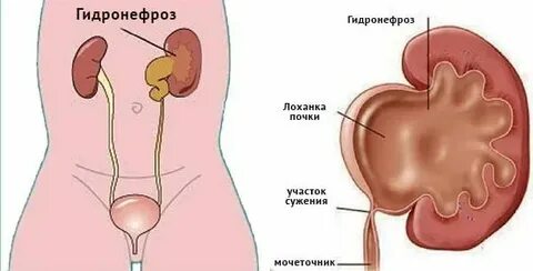 Гидронефроз почек код мкб