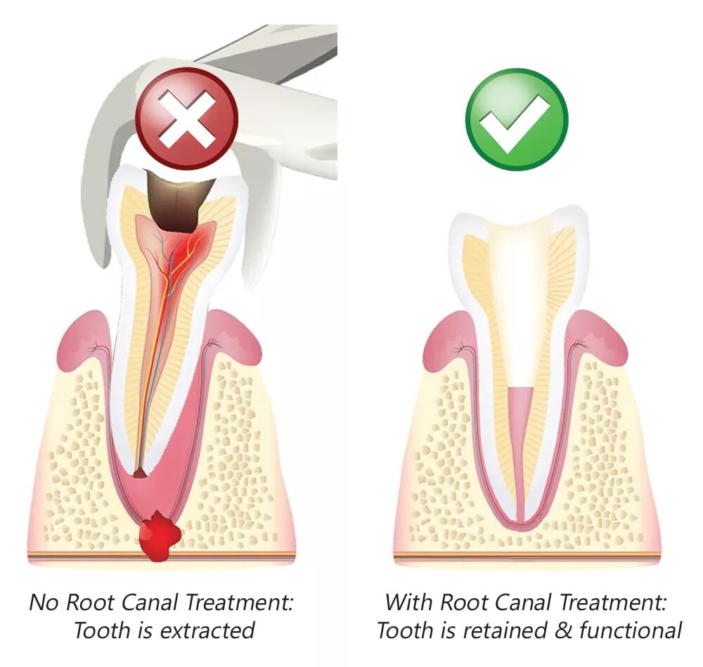 Root canal