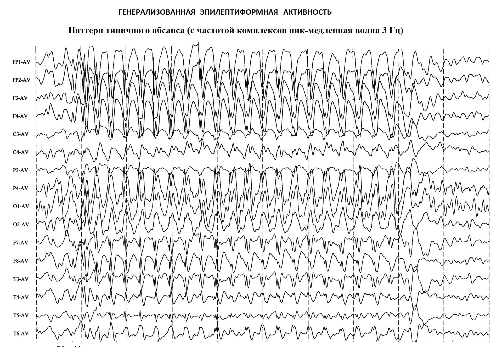 Что значит эпилептиформная активность. Вертексные потенциалы на ЭЭГ. Генерализованная эпилептиформная активность на ЭЭГ У ребенка. Генерализованная эпилепсия ЭЭГ. Эпилептиформные паттерны на ЭЭГ.