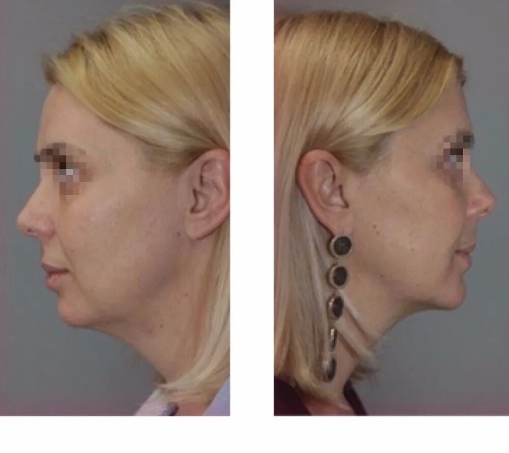 липофилинг век. липофилинг зоны. липофилинг зоны. липофилинг орбитальной зоны. чек-лифтинг (cheek lift) средней зоны лица.