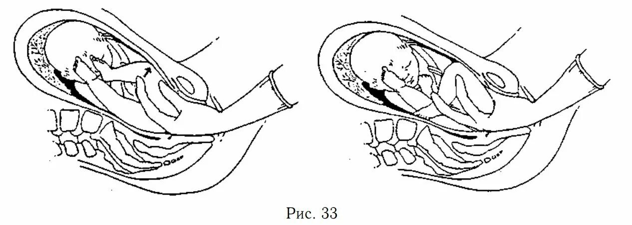 Техника кесарева сечения. Кесарево сечение при предлежании плаценты. Техника извлечения плода при кесаревом сечении. Естественные родовые пути. Ножное предлежание кесарево.