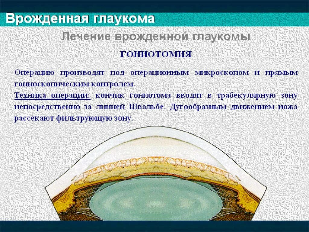 Врожденная глаукома презентация. Виды врожденной глаукомы. Глаукома суть операции