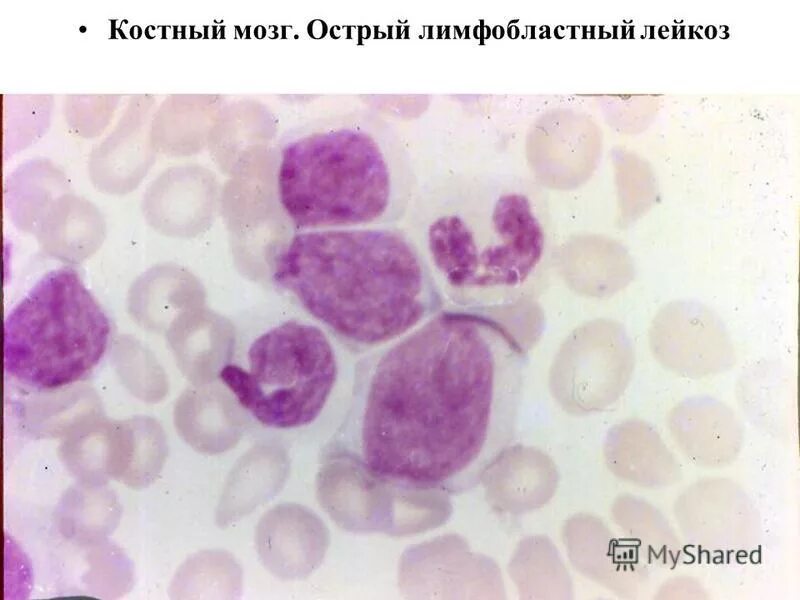 Острый лейкоз миелобластный микроскоп. Острый лимфобластный и миелобластный лейкоз. Лимфобластного лейкоза. Лимфобластный лейкоз картина крови.