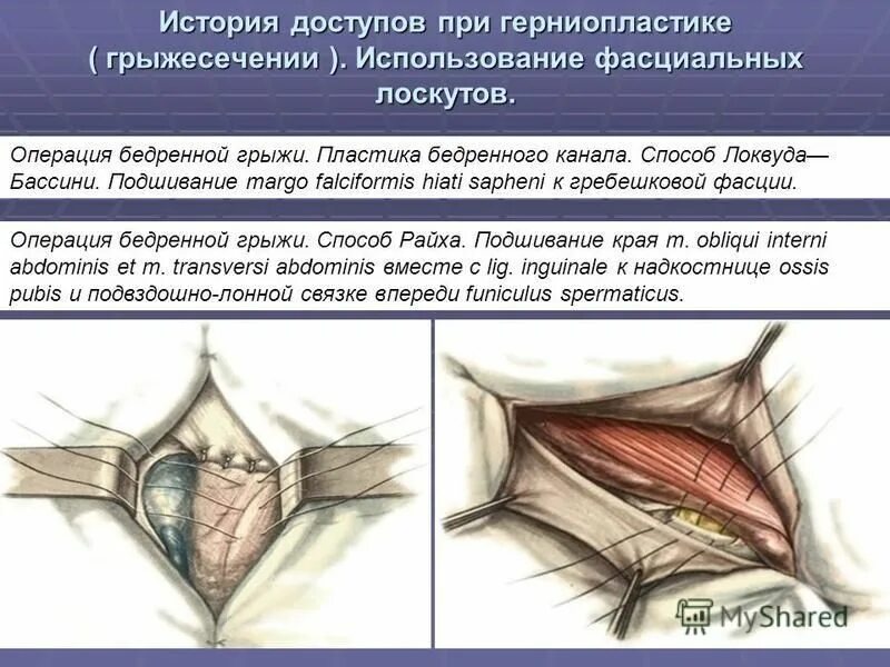 Паховая грыжа методы лечения