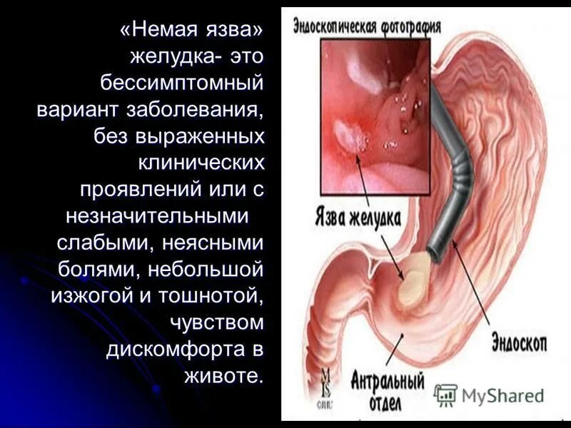 Язва желудка по стадиям. Язвенная болезнь желудка симптомы. Как отличить язву