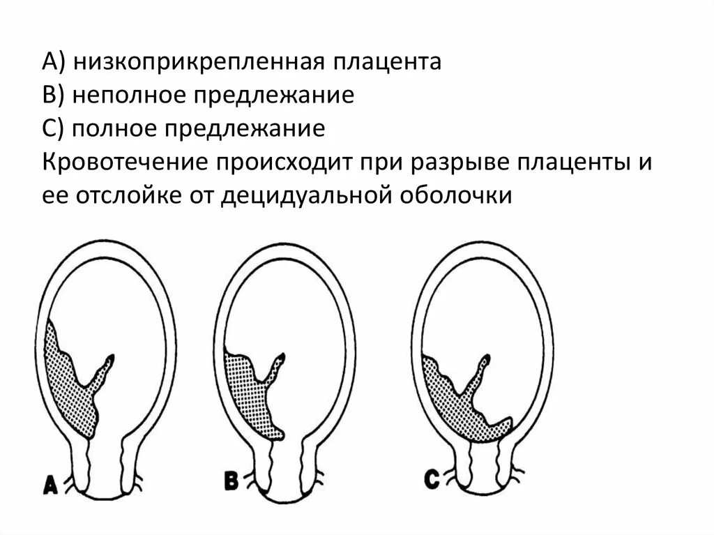 Полное предлежание форум. УЗИ при неполном предлежании плаценты. Низкое предлежание плаценты при беременности. Диагностические критерии предлежание плаценты. Низкая плацентация при беременности предлежание.