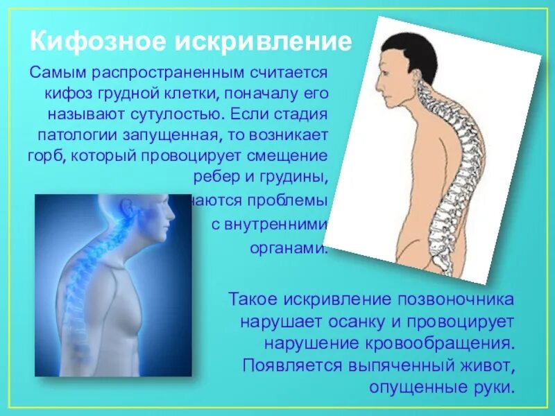 Кифоз. Степени кифоза. Болезнь шейермана мау грудного отдела позвоночника симптомы. Лордоз и кифоз у детей. Грудной кифоз симптомы.