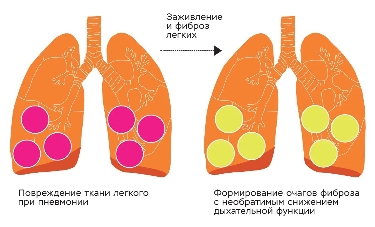 Фиброз легкого после пневмонии. Легкие после после коронавируса. Фиброз легкого после коронавируса. Легкие после поражения