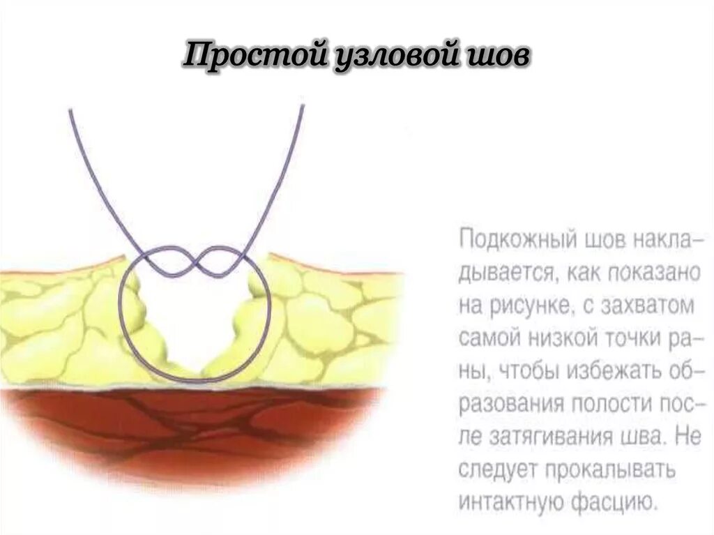 Многоузловой нетоксический зоб 1 степени что это. Простой узловой шов хирургия. Узловой нетоксический зоб 1 степени. Узловой шов техника наложения. Простой узловой хирургический шов техника.