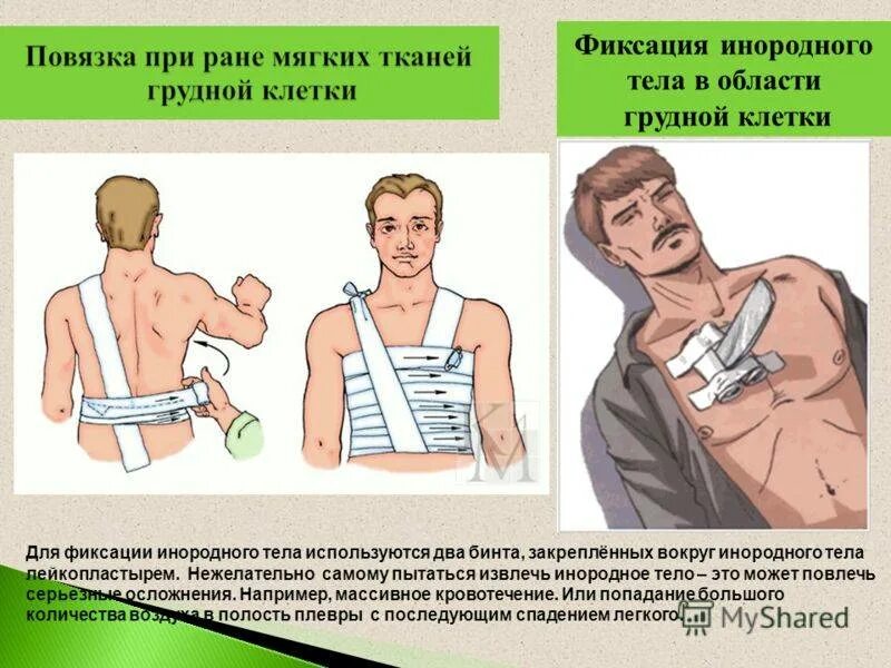 При открытых переломах накладывают повязку