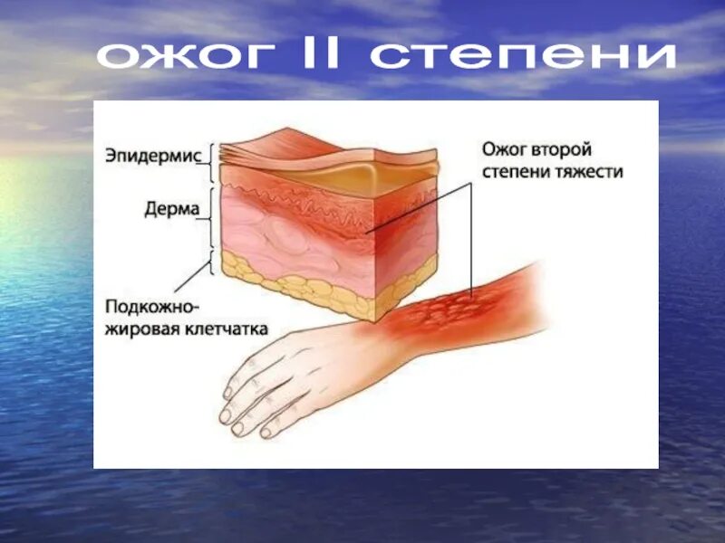 Установите соответствие степени ожога. Термический ожог 2 степени. Солнечный ожог 1 степени. Ожог 2 степени степень волдыри.