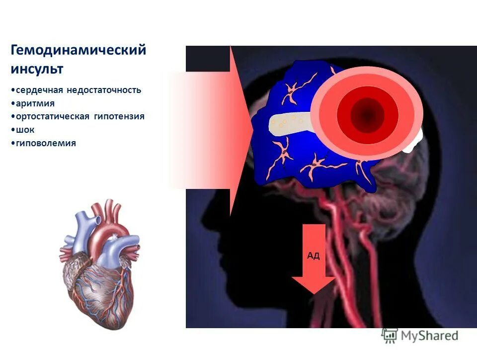 Гемодинамическая сердечная недостаточность