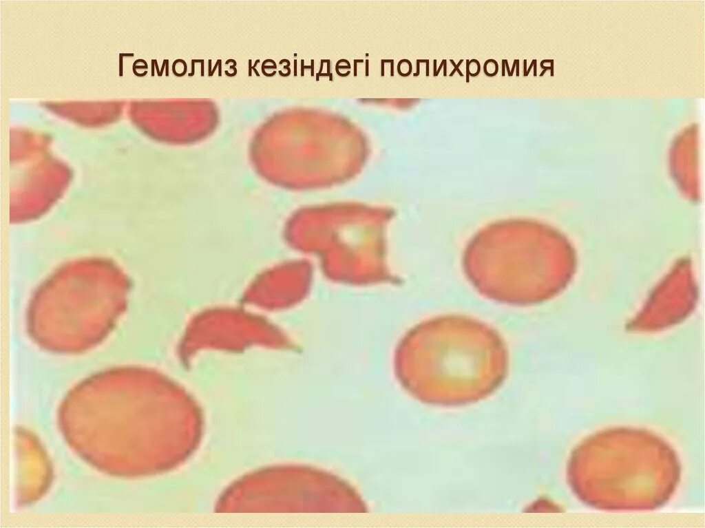 Гемолиз лейкоцитов. Плазмолиз и гемолиз. процесс гемолиза.