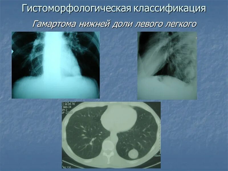 Хондроидная гамартома. Хондроматозная гамартома легкого. Гамартохондрома левого легкого. Доброкачественные опухоли легких гамартома. Образование левой доли легкого