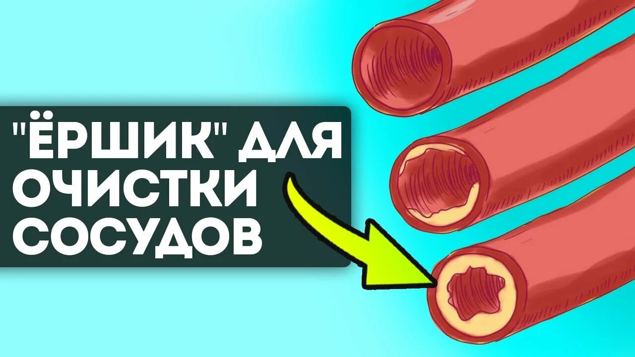 Как чистить сосуды сердца. Продукты засоряющие сосуды. какие продукты забивают сосуды. забитые сосуды от майонеза.