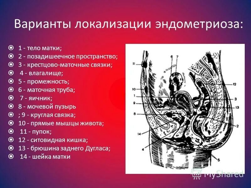 Маточных связки матки. Эндометриоз дугласово пространство. Крестцово маточные связки. Локализация эндометриоза. Маточно прямокишечное пространство.