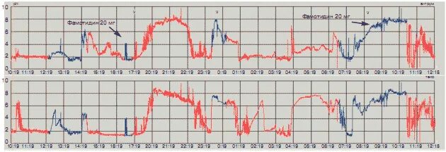 Рн грамма. Ph грамма желудка. Физиологический рефлюкс. Усреднённая суточная ph-грамма желудка после приёма омепразола. Ph грамма.