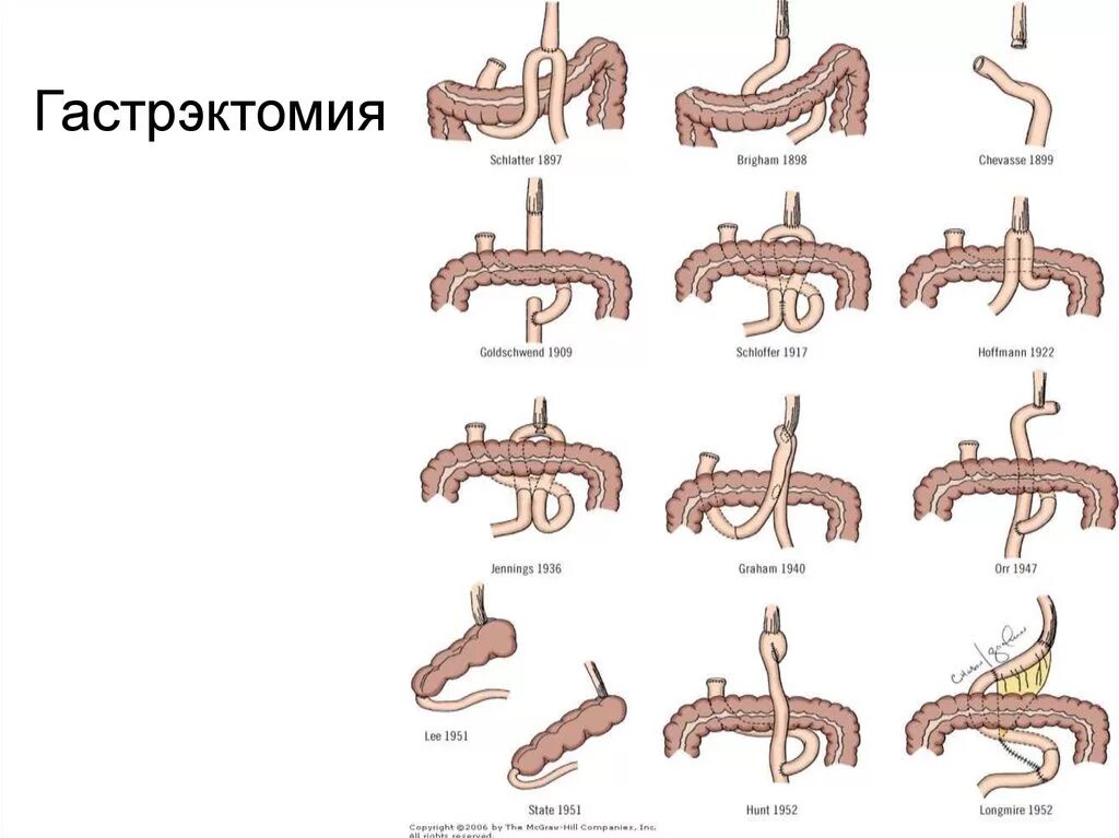 После удаления части желудка. Схема операции при резекции желудка. Гастрэктомия анастомоз. Гастрэктомия по Сигалу ход операции. Тотальная гастрэктомия схема.