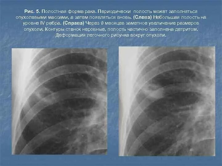 Полостные образования в легких рентген. Полостные образования в легких на кт. Междолевая плевра справа. Полостные образования в легких