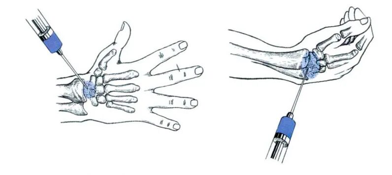 Блокада заболевание. Пункция лучезапястного сустава методика. Пункция локтевого сустава. Блокада запястного сустава. Блокада лучезапястного сустава техника.