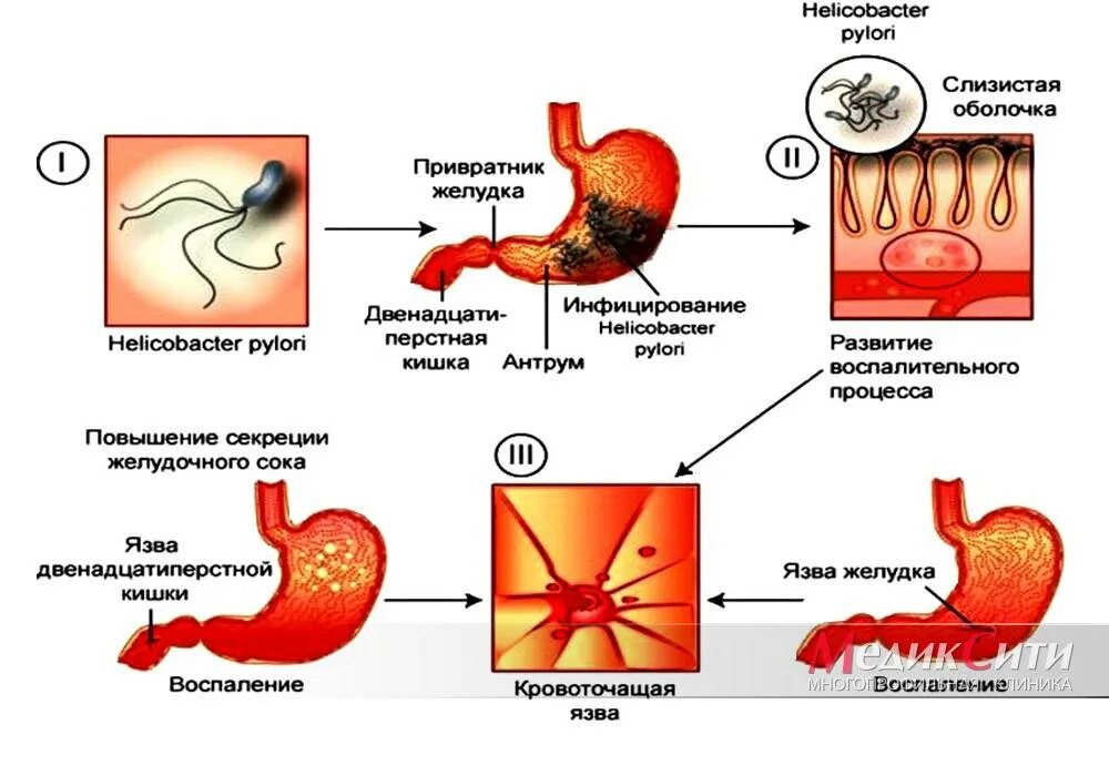 Боли после язвы желудка. Язвенная болезнь желудка хеликобактер пилори. Хеликобактер пилори язвенная болезнь. Патогенез язвенной болезни желудка хеликобактер. Стадии болезнь желудка язвенная болезнь.