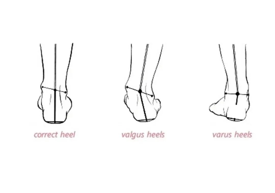 Пятки внутрь. Варус вальгусная деформация. Варусная деформация голеностопного. Вальгус Варус плоскостопие.