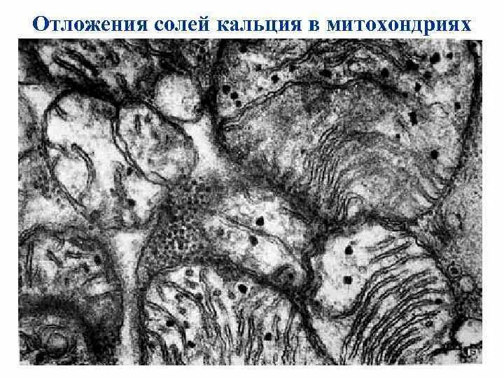 Отложение кальция. Отложение солей кальция. отложение кальциевых солей. отложение кальция в суставах. отложение солей кальция в организме.