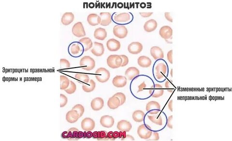 Изменение формы эритроцитов