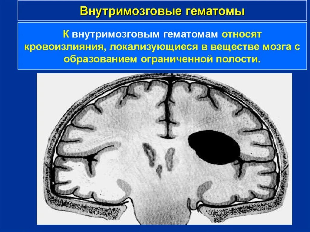 Субарахноидальное кровоизлияние в мозг. Арахноидальная гематома. Субдуральная и субарахноидальная гематома. Внутримозговое кровоизлияние. Гематома мозга операция