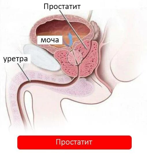 Простата действий. Хронический простатит.