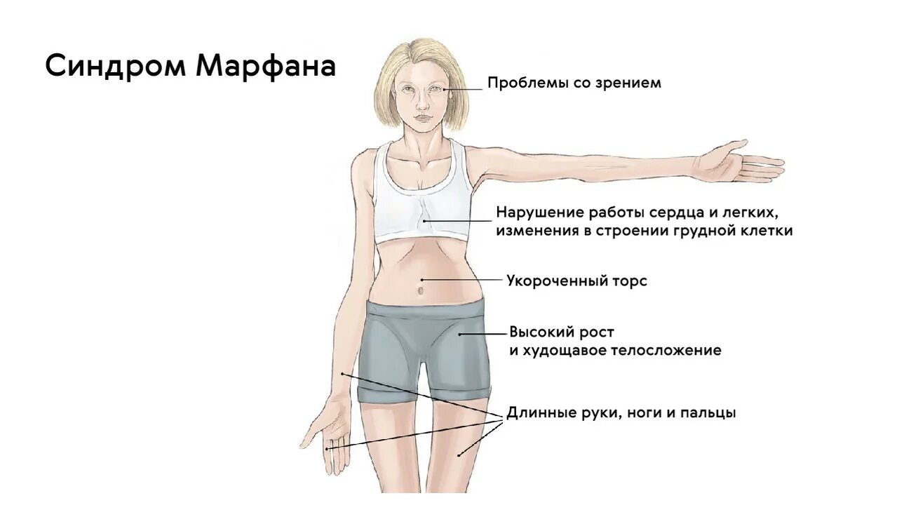 Синдром вращающейся башни. Синдром марфана диагностические признаки. синдром марфана клинические проявления. синдром марфана клинические симптомы. механизм развития синдрома марфана.