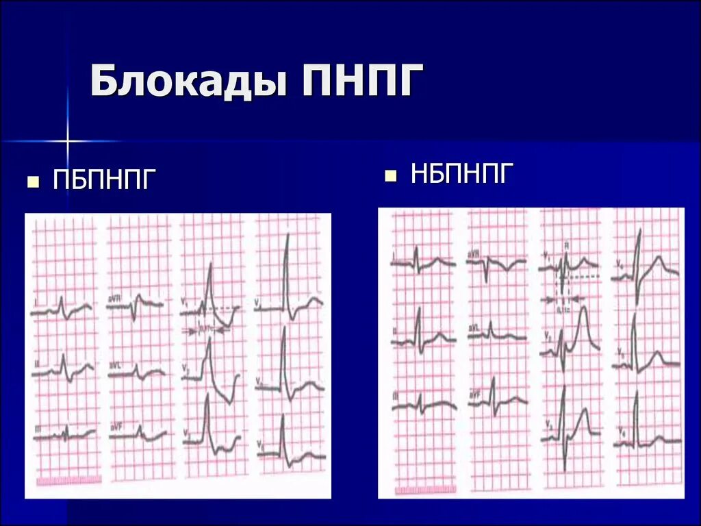 Гиса блокада пнпг. Неполная блокада ПНПГ на ЭКГ. Блокада правой ножек пучка Гиса на ЭКГ. Блокада правой ножки пучка Гиса на ЭКГ. ЭКГ при блокаде Гиса правой ножки.