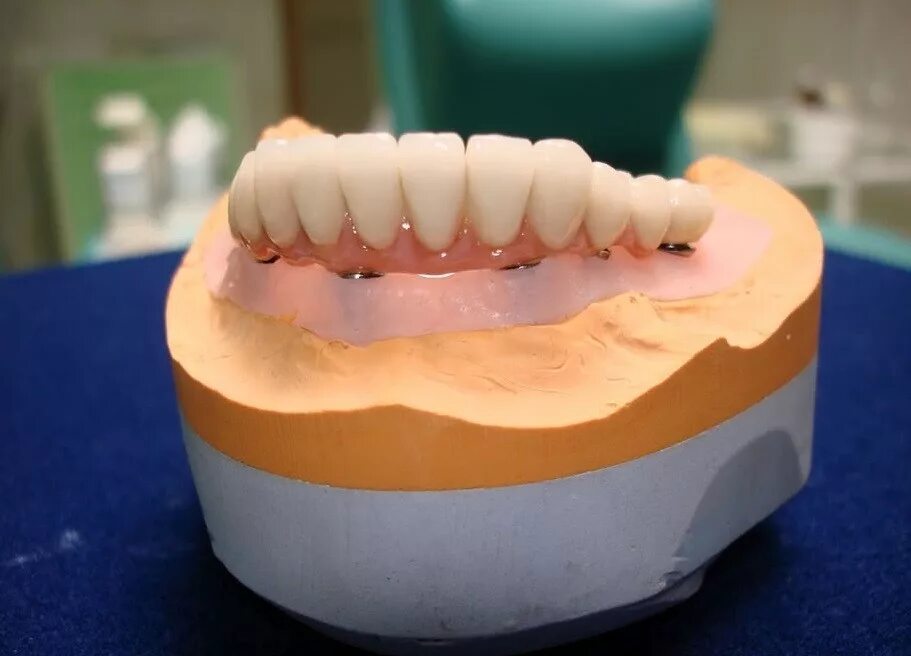 Несъемные протезы зубов. Протезист рейтинг