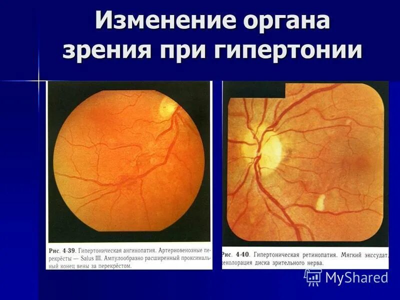 Болезнь глазного дна. Гипертоническая ретинопатия глазное дно. Гипертоническая ретинопатия офтальмоскопия. Гипертоническая ангиопатия сетчатки глазное дно. Глазное дно при артериальной гипертонии.