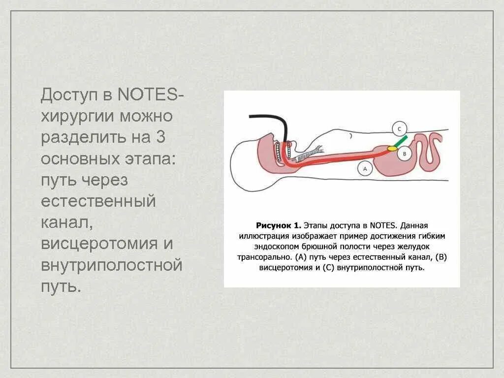 Operation note. Транслюминальная хирургия. notes технологии в хирургии. транслюминальная хирургия (notes хирургия) это.