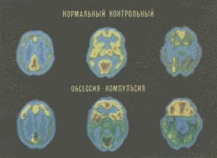 Мозг при окр