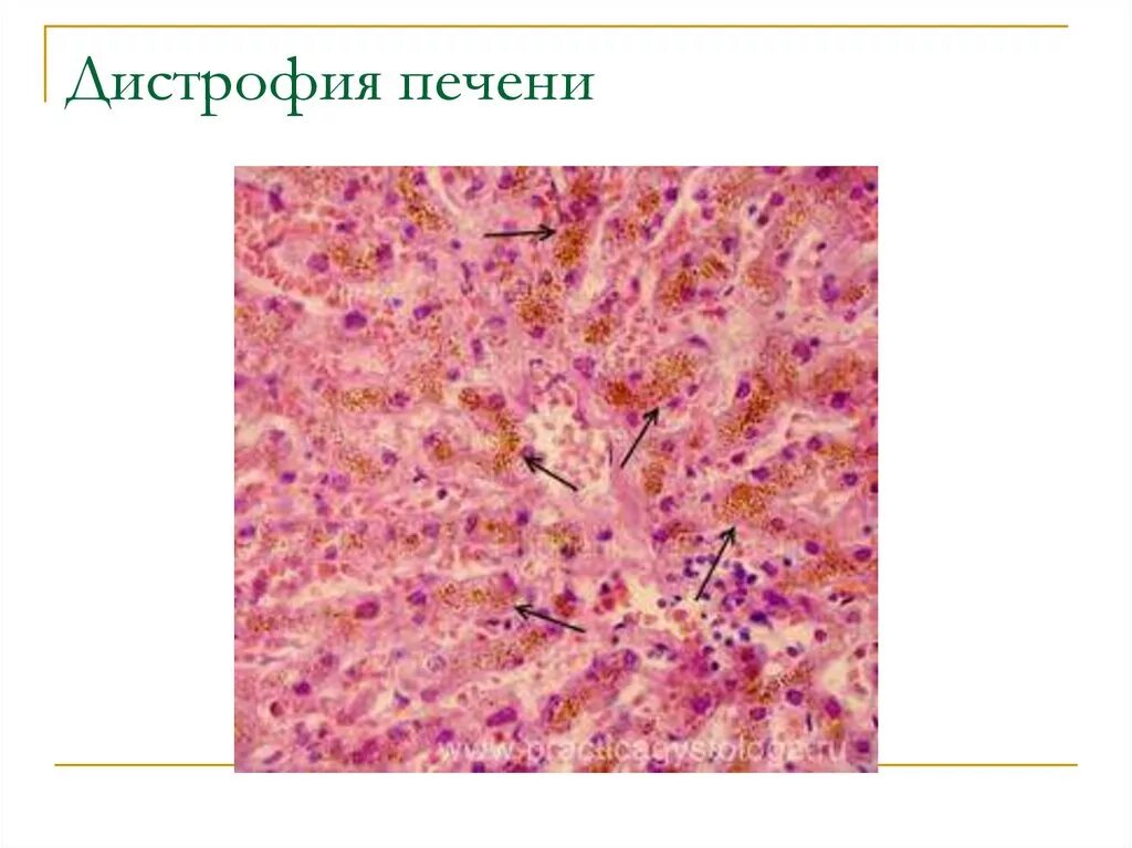 Диффузная дистрофия. Гидропическая дистрофия печени гистология. Зернистая дистрофия печени гистология. Гидропическая белковая дистрофия. Зернистая белковая дистрофия печени гистология.