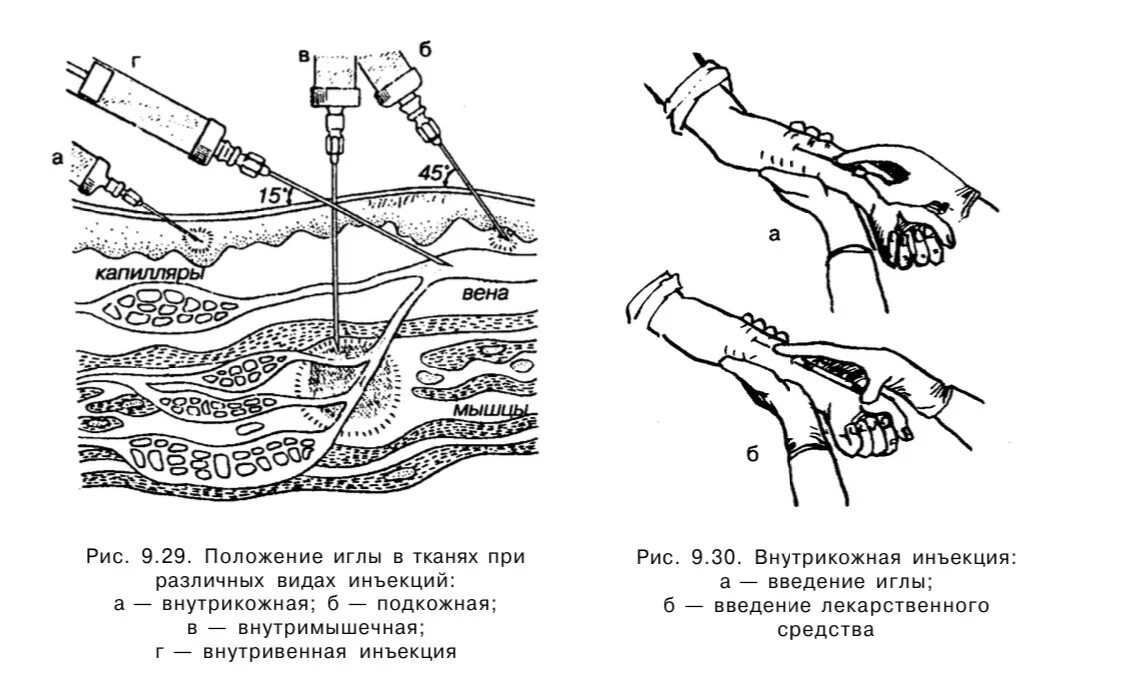 Угол введения иглы при внутримышечной инъекции в плечо. Угол введения иглы при внутривенном введении. Алгоритм инъекций подкожно внутримышечно внутрикожно. Техника внутрикожных инъекций схема. Подкожные инъекции техника выполнения