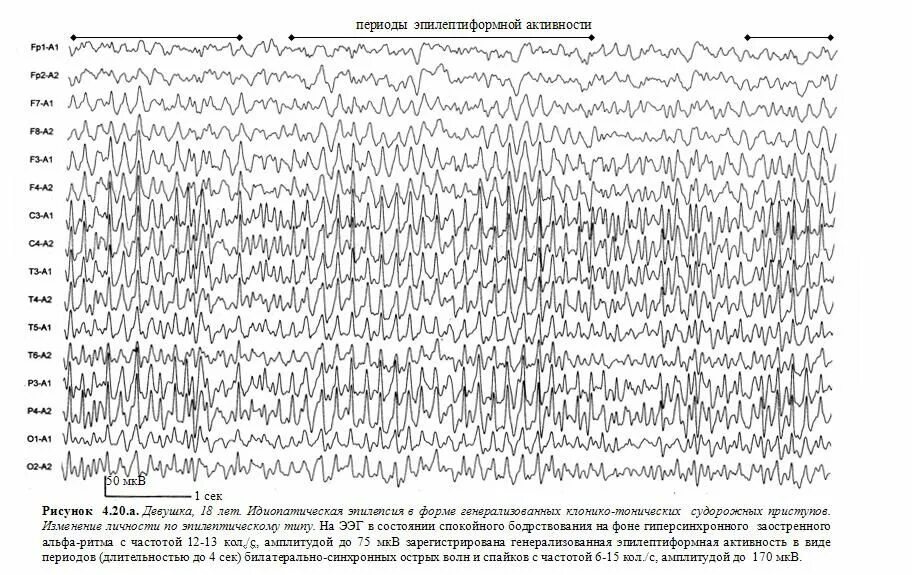 Пароксизмальная ээг. ЭЭГ заключение эпилептиформная активность. Эпилептиформные паттерны на ЭЭГ. ЭЭГ эпилепсия пик-волна. Эпилептиформная активность на ЭЭГ У ребенка что это.