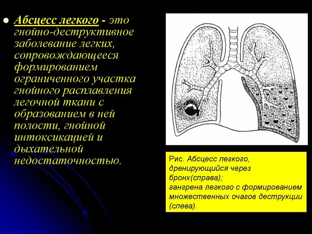 Эмпиема латынь. Дренирующийся абсцесс легкого. Гематогенный абсцесс легкого. Плевральный абсцесс легкого.